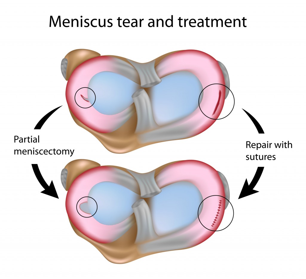 knee-surgery-for-a-meniscus-tear-not-if-you-re-middle-aged